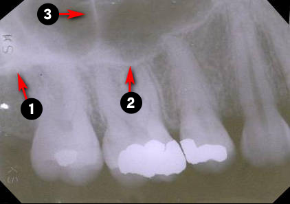 maxillary-premolars1q