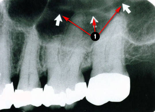 maxillary-premolars2q