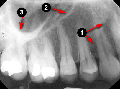 maxillary-premolars2q