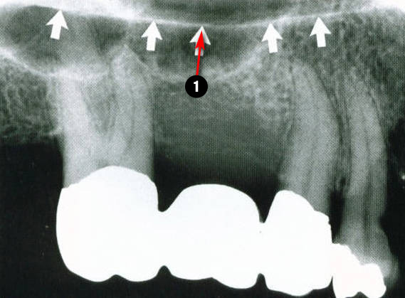 maxillary-premolars3q