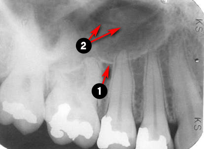 maxillary-premolars3q