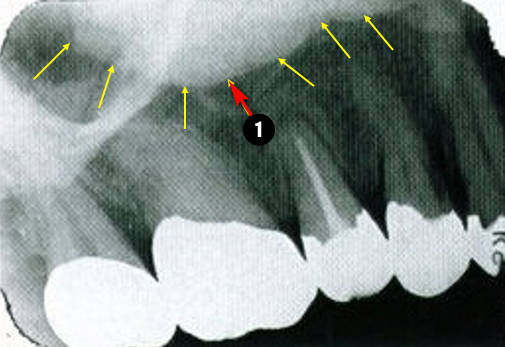 maxillary-premolars4q