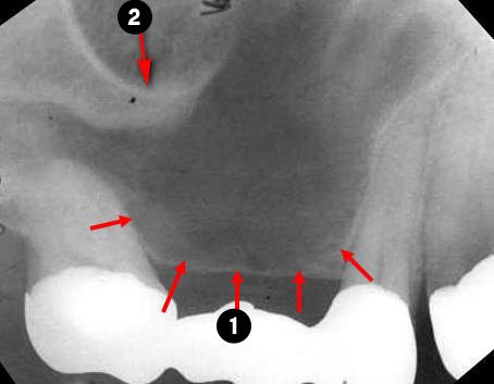 maxillary-premolars4q