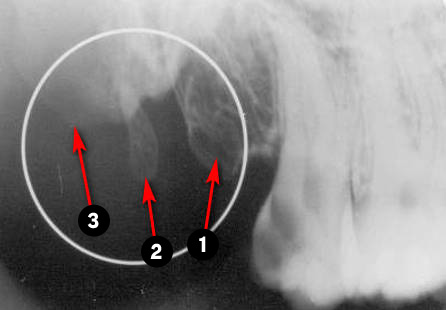 maxillary-premolars5q